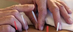 acupuntura-sao-joao-del-rei-1402855069